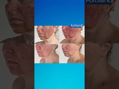 হিফু বনাম ফ্যাকশনাল সিও২ লেজার, কোনটা পছন্দ?