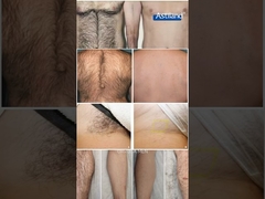 লেজার চুল অপসারণ -- আগে ও পরে