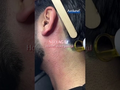 ডায়োড লেজার বনাম এনডি ইয়াগ লেজার, কোনটা পছন্দ?