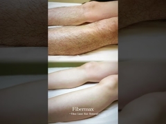 সর্বশেষ ফাইবার লেজার হেয়ার অপসারণ মেশিন, Astiland ফাইবারম্যাক্স!